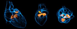 Augustinum Cardiology Academy: TAVI – State of the Art und Perspektive