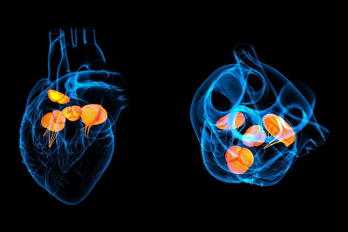 Verschiedene Blickwinkel auf ein Herz mit einer Transkatheder-Aortenklappenimplantation 